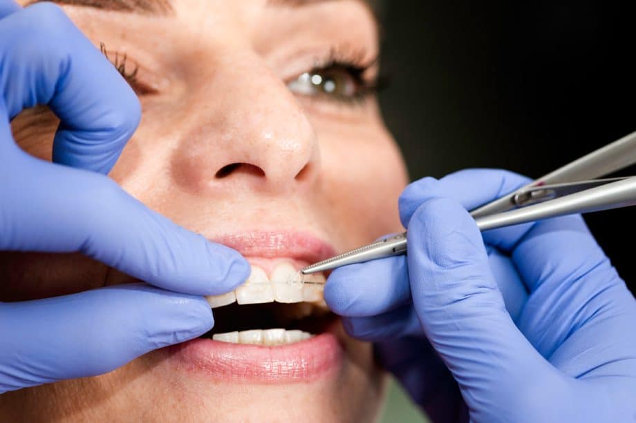 How Long Do Braces Take?