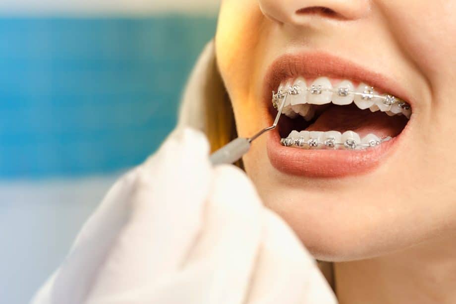 How Long Do You Have To Wear Braces?
